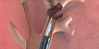Miniprobe System  