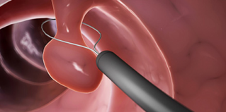 Endotherapy