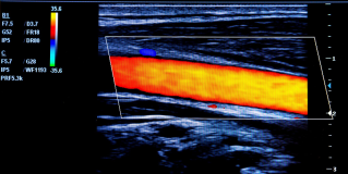 Endoscopic Ultrasound (EUS)