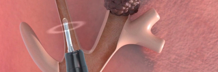 Miniprobe System