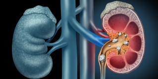 Lithotripsy