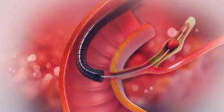 Duodenoscopes & ERCP