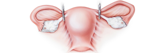 Hysterectomy